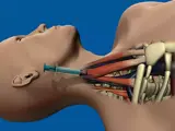 catherization for internal jugular
